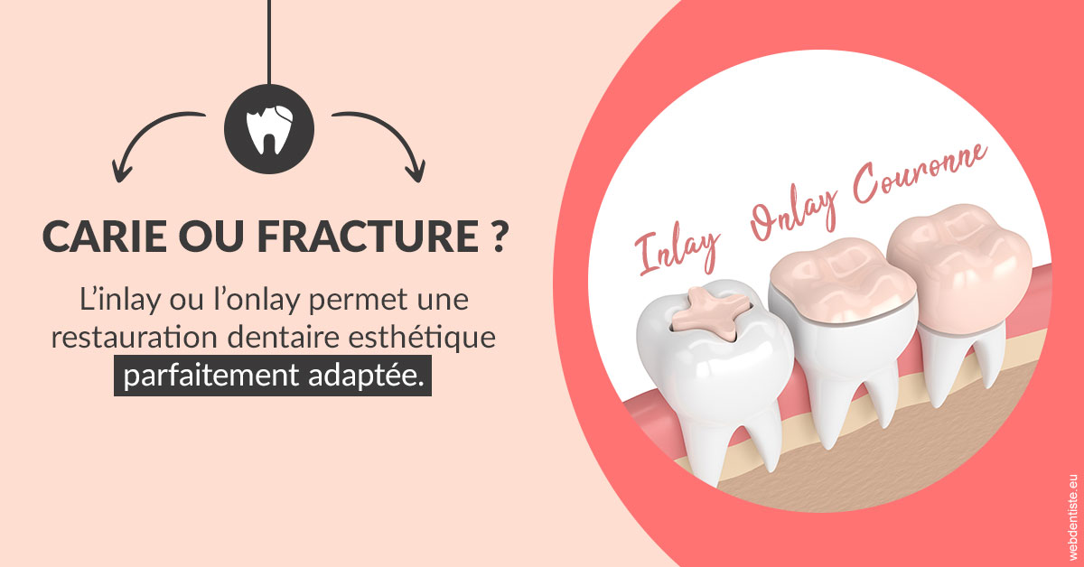 https://selarl-grangeon-bissuel-et-associes.chirurgiens-dentistes.fr/T2 2023 - Carie ou fracture 2