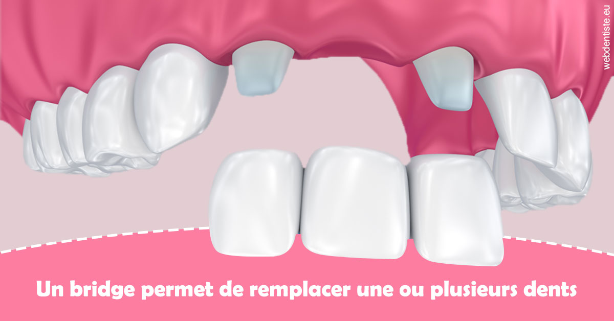 https://selarl-grangeon-bissuel-et-associes.chirurgiens-dentistes.fr/Bridge remplacer dents 2