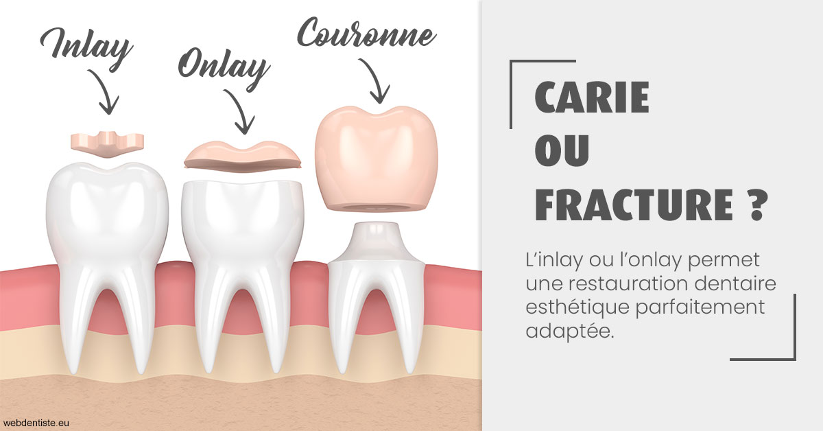 https://selarl-grangeon-bissuel-et-associes.chirurgiens-dentistes.fr/T2 2023 - Carie ou fracture 1
