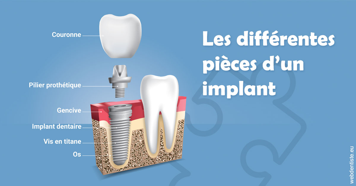 https://selarl-grangeon-bissuel-et-associes.chirurgiens-dentistes.fr/Les différentes pièces d’un implant 1